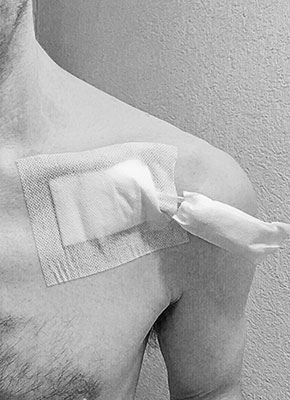 Catheter placement. You can see some atrophy in my left shoulder, which I hope to resolve after the whole procedure.